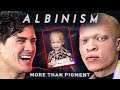 I spent a day with people w/ ALBINISM